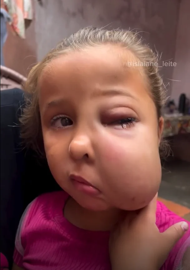 Lívia, an 8-year-old girl diagnosed with a hemangioma — a rare facial tumour — who urgently needs treatment in São Paulo